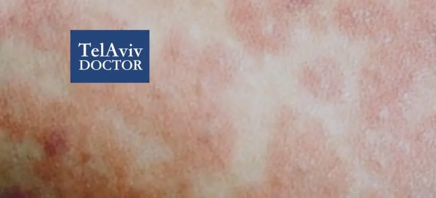 Measles Outbreak In Israel Health Advice | Tel Aviv Doctor